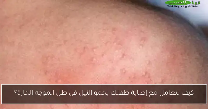 كيف تتعامل مع إصابة طفلك بحمو النيل في ظل الموجة الحارة؟