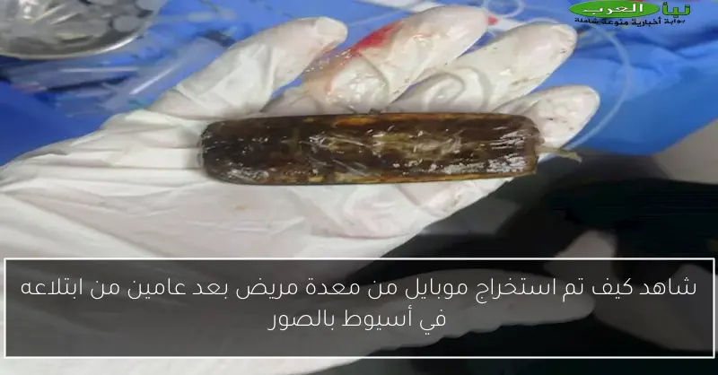 شاهد كيف تم استخراج موبايل من معدة مريض بعد عامين من ابتلاعه في أسيوط بالصور
