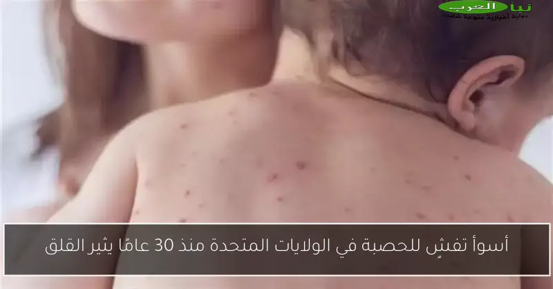 أسوأ تفشٍ للحصبة في الولايات المتحدة منذ 30 عامًا يثير القلق