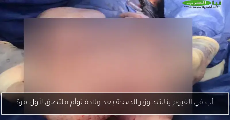 أب في الفيوم يناشد وزير الصحة بعد ولادة توأم ملتصق لأول مرة