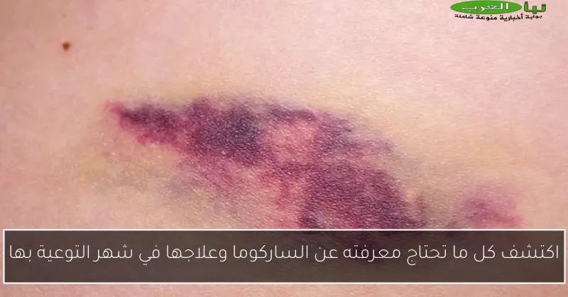 اكتشف كل ما تحتاج معرفته عن الساركوما وعلاجها في شهر التوعية بها
