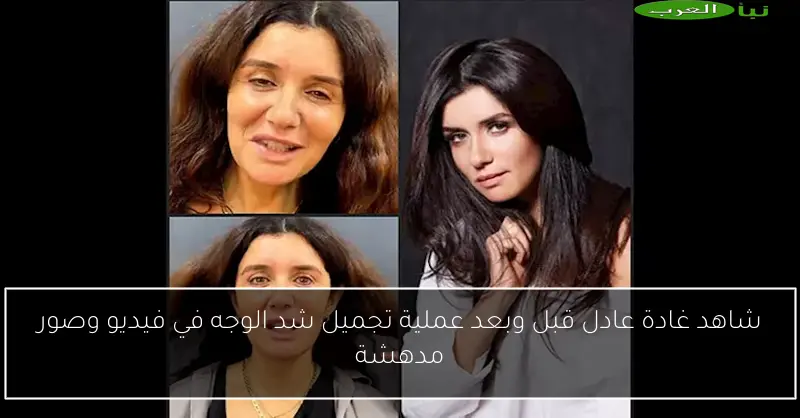 شاهد غادة عادل قبل وبعد عملية تجميل شد الوجه في فيديو وصور مدهشة
