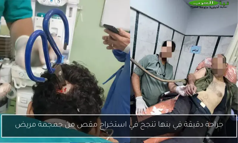 جراحة دقيقة في بنها تنجح في استخراج مقص من جمجمة مريض