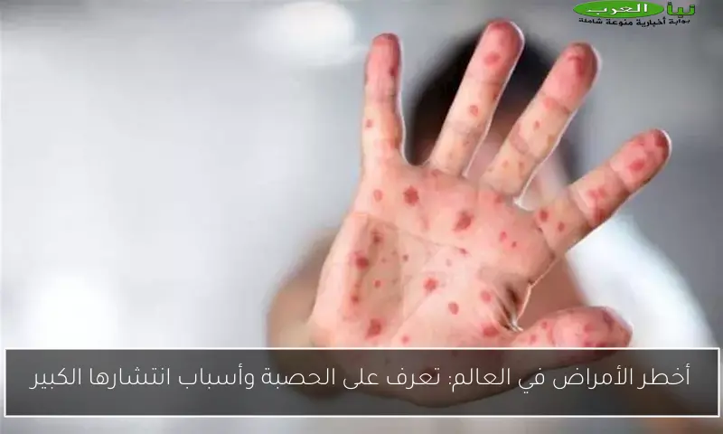 أخطر الأمراض في العالم: تعرف على الحصبة وأسباب انتشارها الكبير