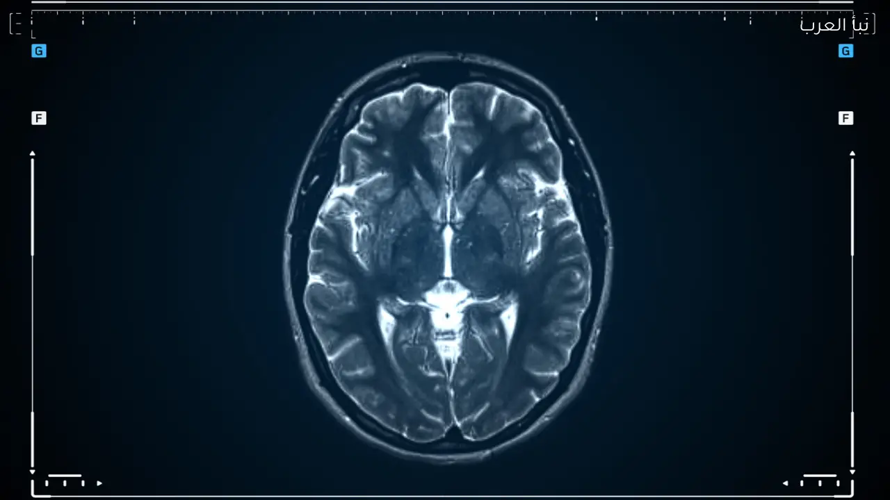 علماء ينجحون في تجميد أنسجة الدماغ وإعادة تنشيطها بعد ذوبانها